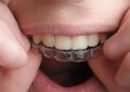 16 Significados de Sonhar com Alinhamento Dentário