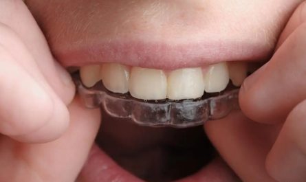 16 Significados de Sonhar com Alinhamento Dentário