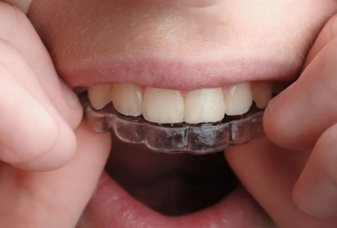 16 Significados de Sonhar com Alinhamento Dentário