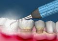 12 Significados de Sonhar com Limpeza dos Dentes