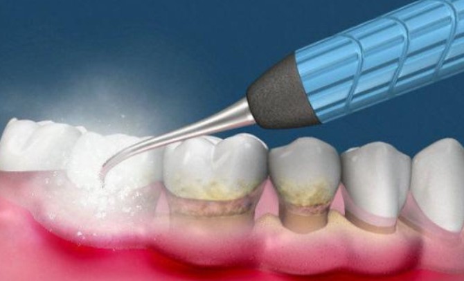 12 Significados de Sonhar com Limpeza dos Dentes
