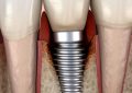 18 Significados de Sonhar com Implantes Dentários