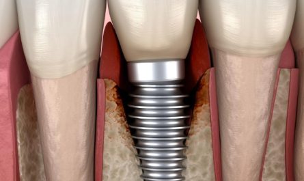 18 Significados de Sonhar com Implantes Dentários