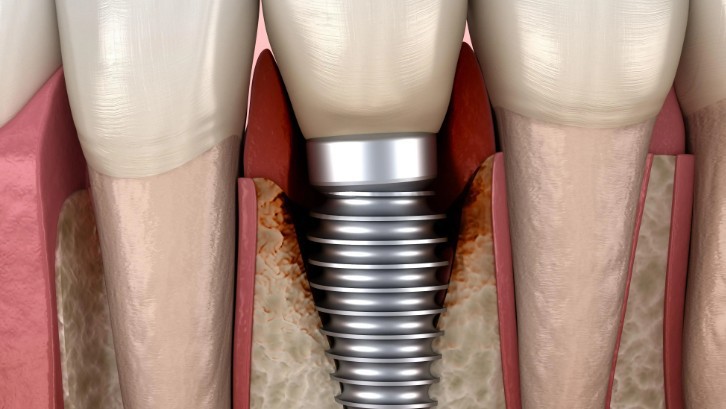 18 Significados de Sonhar com Implantes Dentários