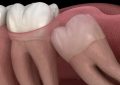 16 Significados de Sonhar com Dentes do Siso
