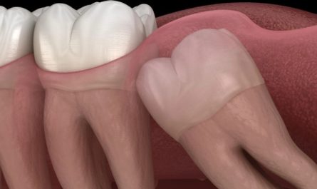 16 Significados de Sonhar com Dentes do Siso