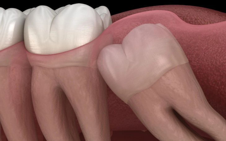 16 Significados de Sonhar com Dentes do Siso