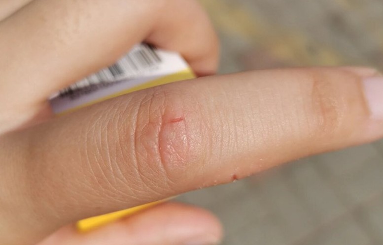 28 Significados de Sonhar com um Dedo Ferido