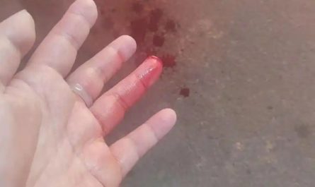 30 Significados de Sonhar com um Dedo Decepado