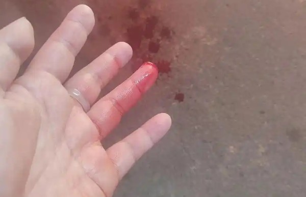 30 Significados de Sonhar com um Dedo Decepado